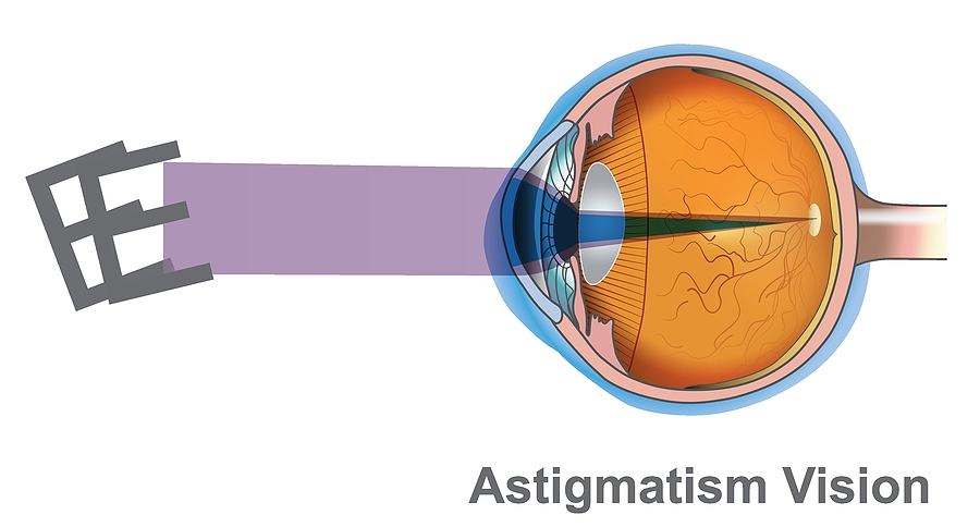 Astigmatism Vision