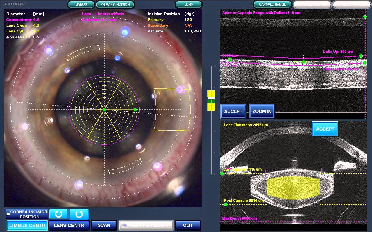 LenSx assisted Cataract Surgery