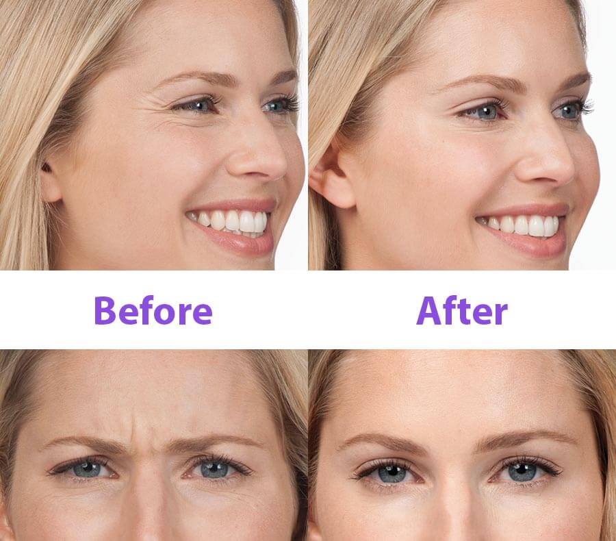 Forehead Lines & Frown Lines Before & After Photos New Jersey