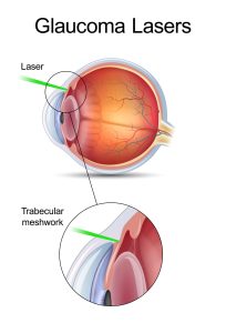 Laser Glaucoma Surgery