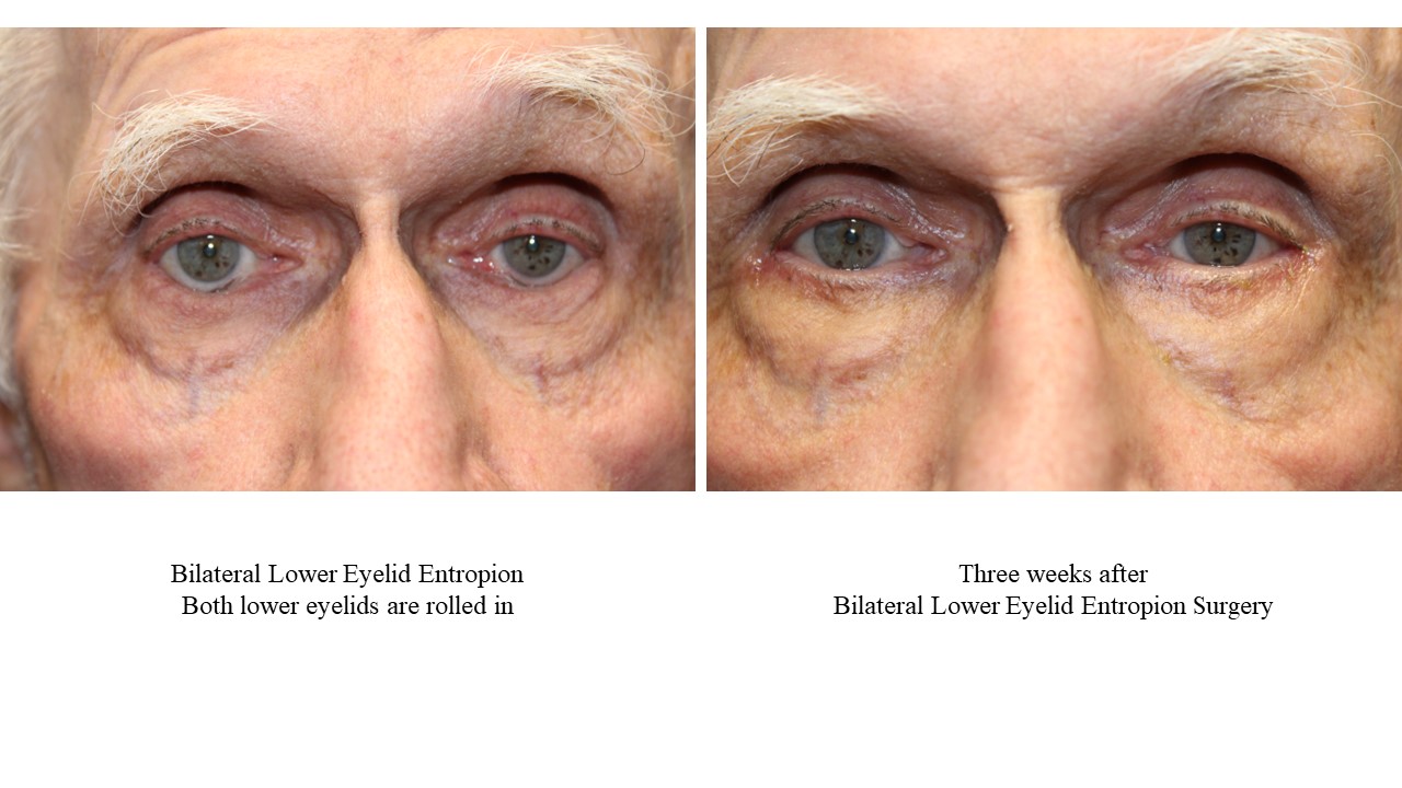 blepharoplasty eyelid surgery