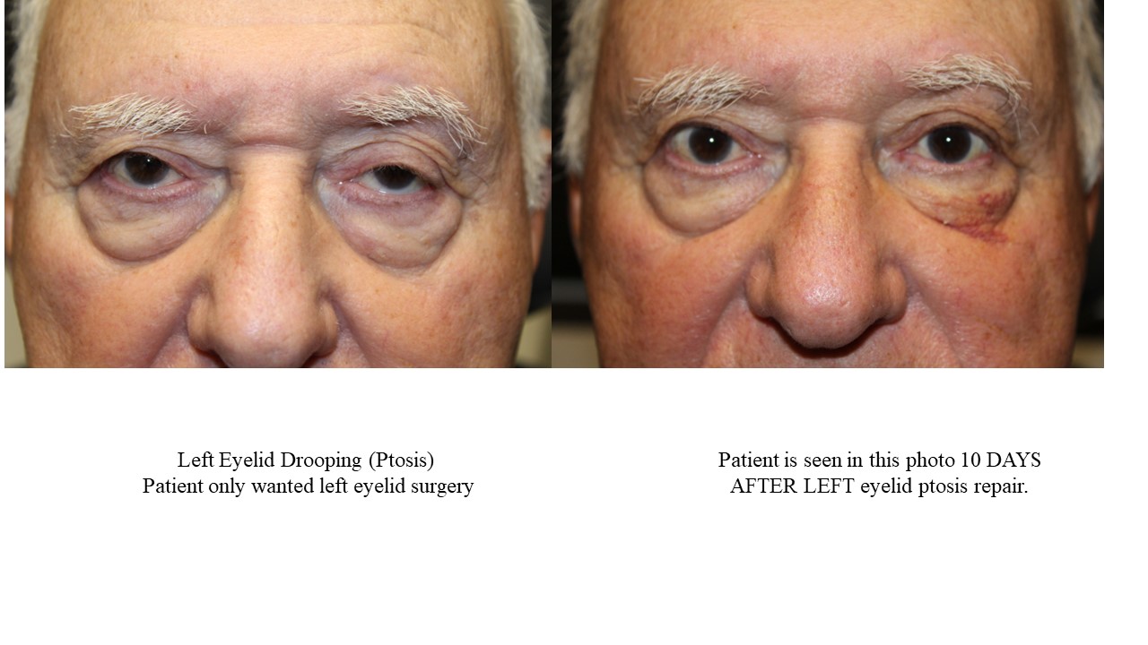 blepharoplasty eyelid surgery